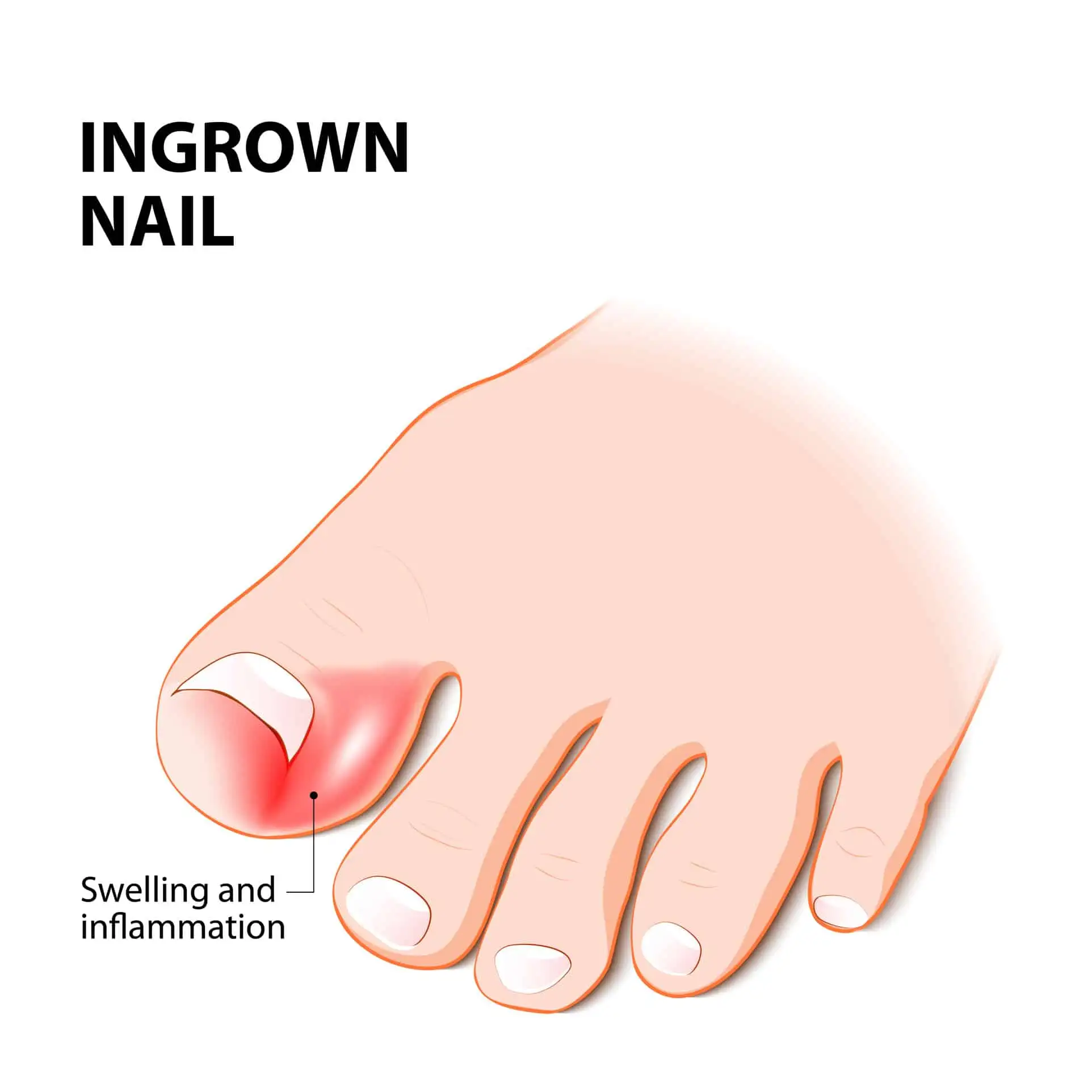 What Is The Fastest Way To Get Rid Of An Ingrown Toenail? Toe nail treatment