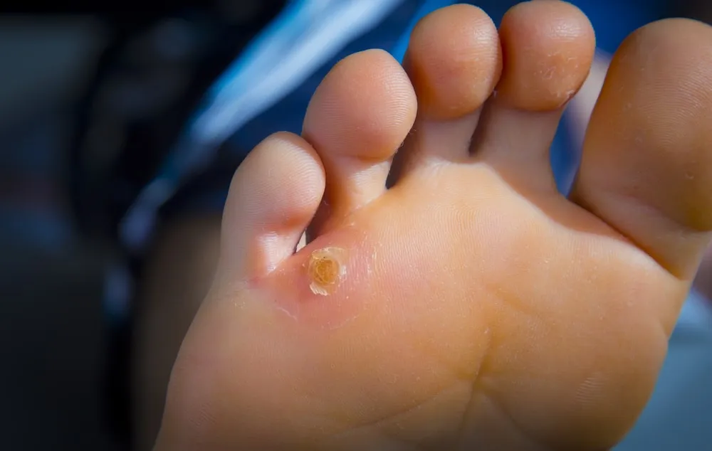 corn-on-the-pinky-toe-calluses-causes-and-treatments-canyon-oaks