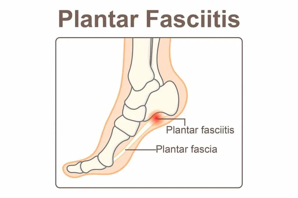 Plantar fasciitis so bad I can't walk? Call us today for an appointment.