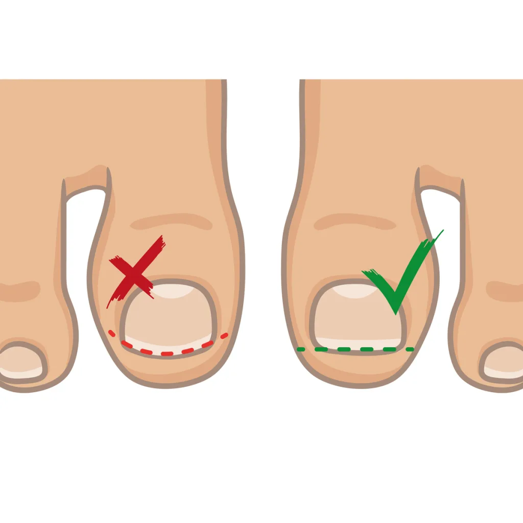 What Is The Fastest Way To Get Rid Of An Ingrown Toenail? Toe nail treatment