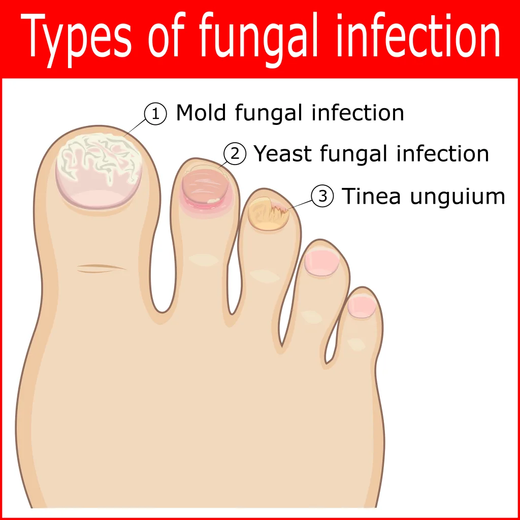 Causes of Fungal Nail Infection | Symptoms of Fungal Nail Infection