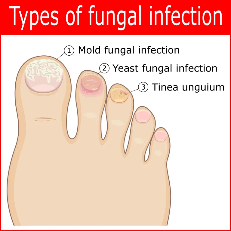 Fungal Nail Infection: Overview, Causes & Treatments