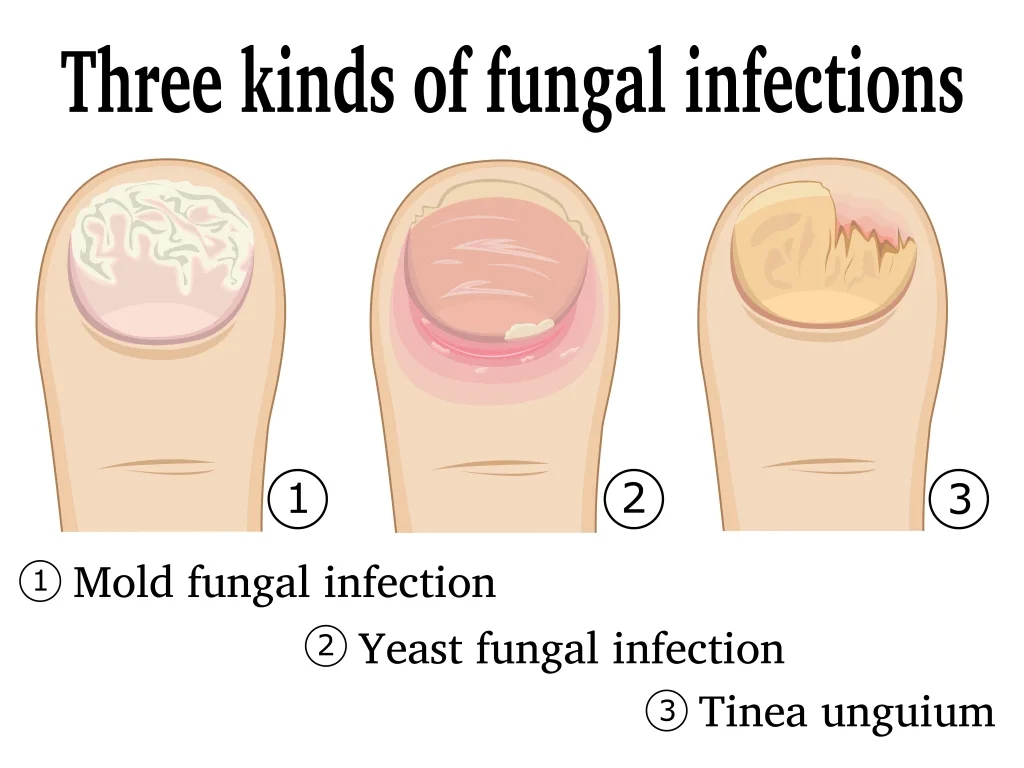 How Laser Toenail Fungus Therapy Works - Toenail Fungus