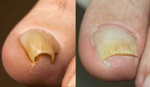 toenails infection nails cases patients nail bed antibiotics procedure toe