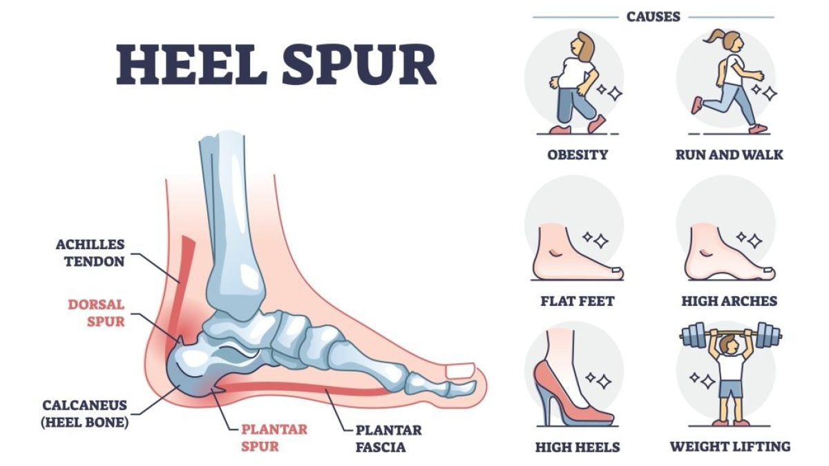 Can a Heel Spur Go Away On Its Own   Heel Spur Treatment