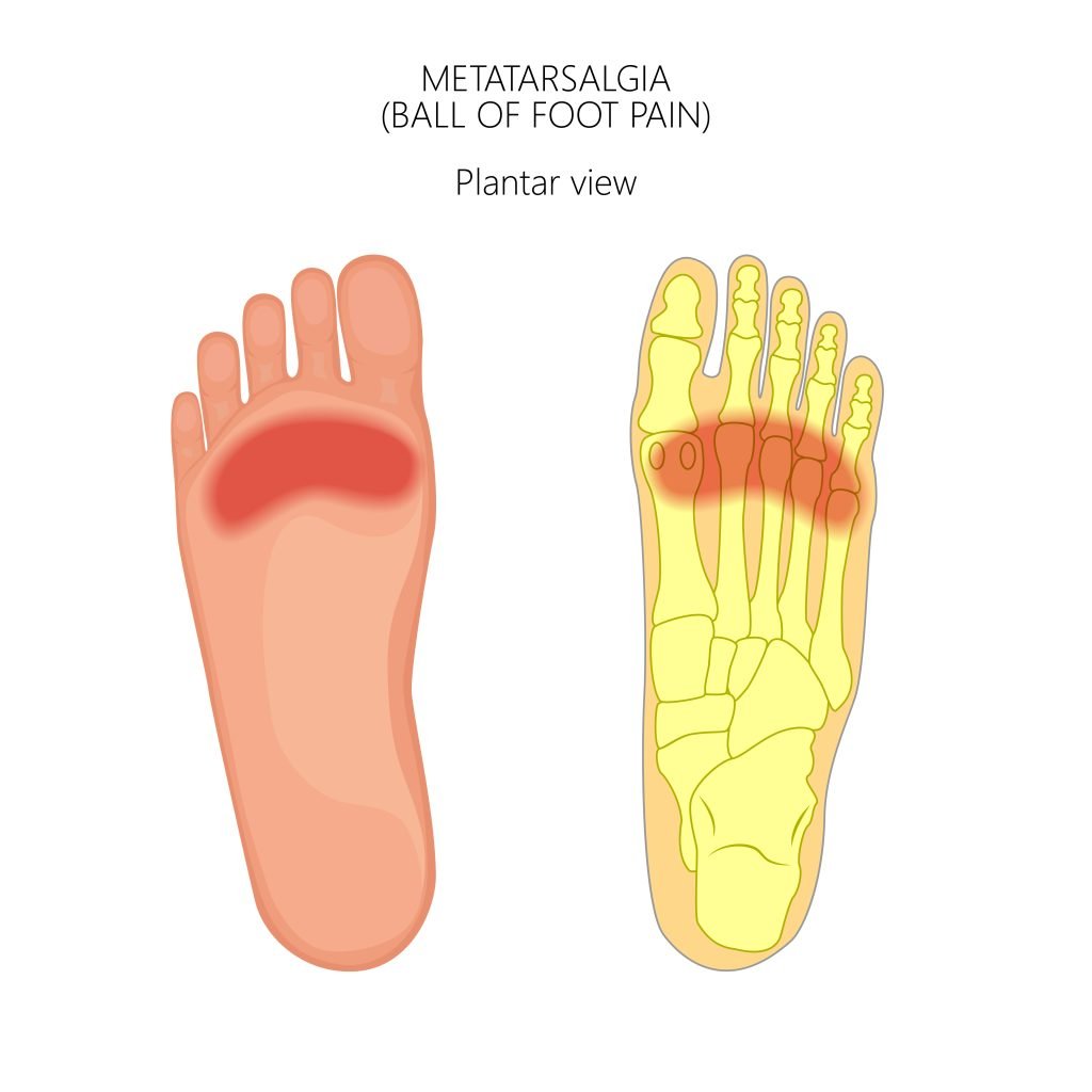 How Can I Treat My Ball of Foot Pain? | Metatarsalgia Care