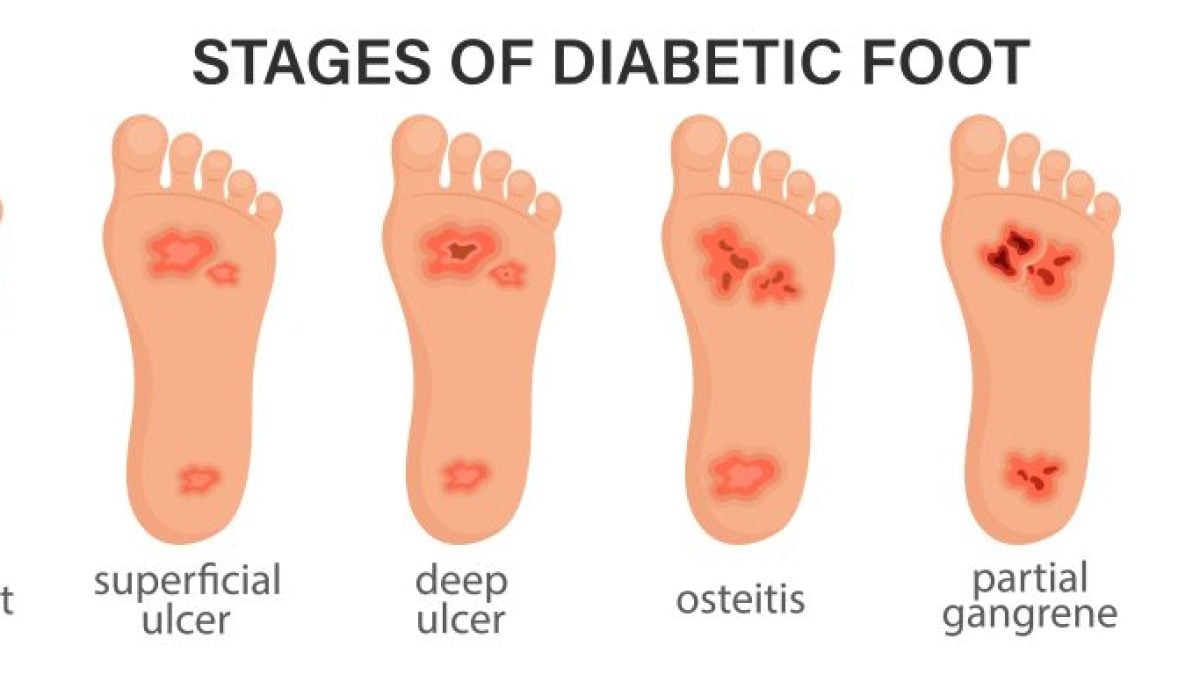 What Are Diabetic Foot Symptoms, and How Can a Podiatrist Help