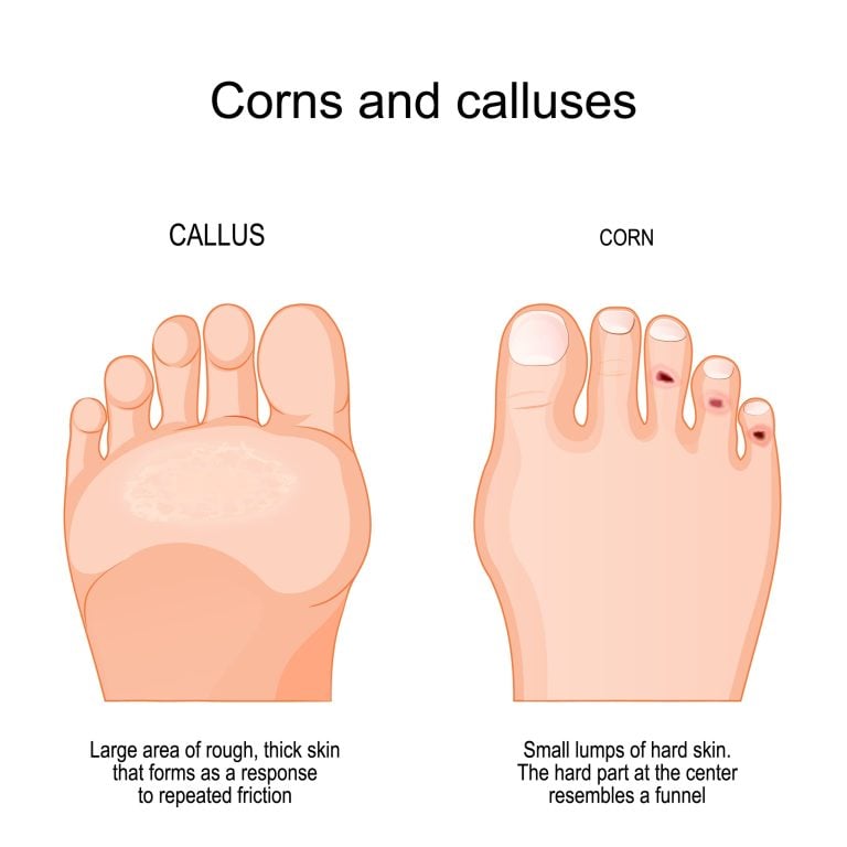 Painful Corn In Toe Learn About At Home Care Evidence Based Podiatry Treatments That Work Skin Corns Clinic