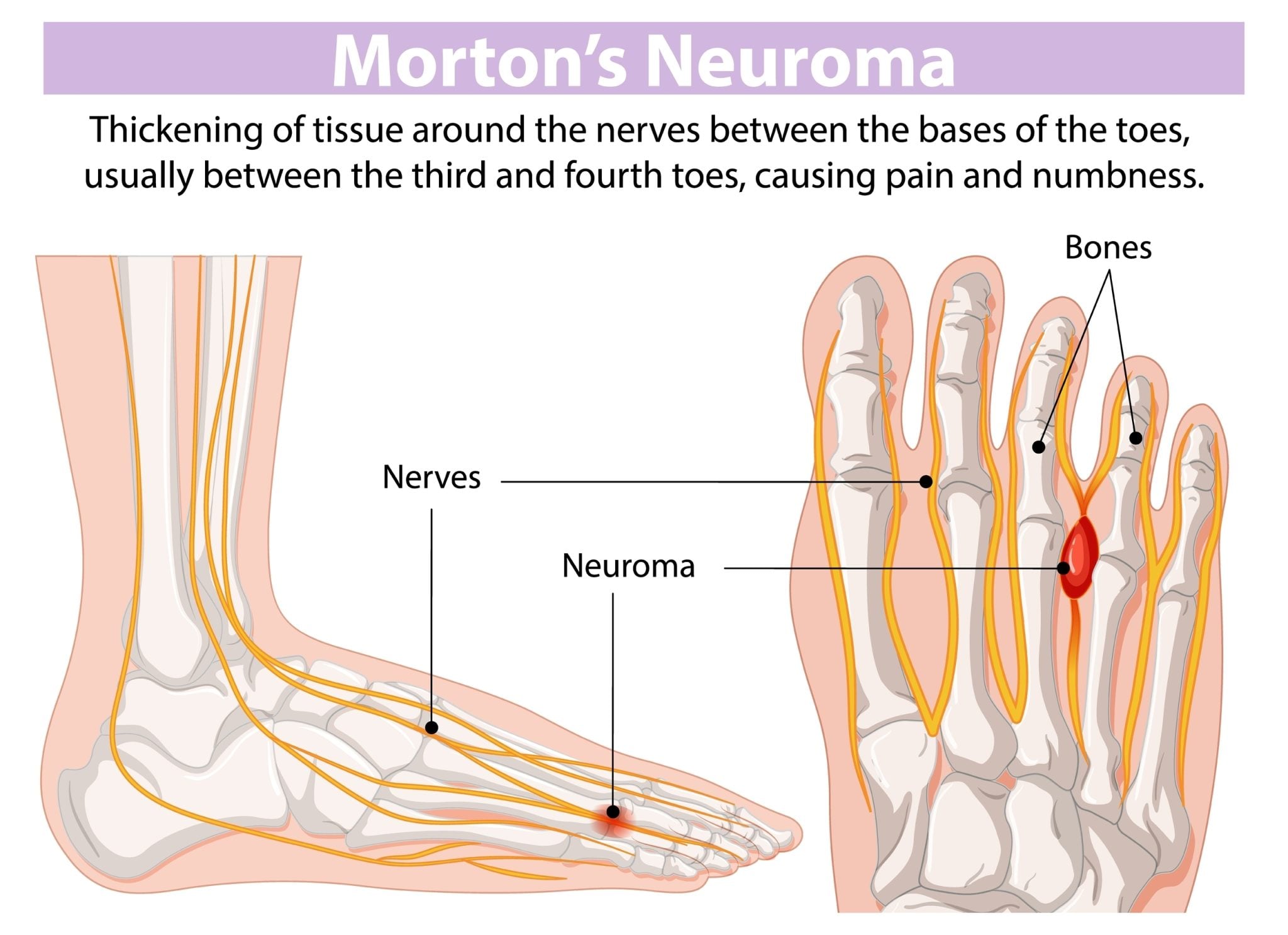 Morton's Neuralgia: Causes, Symptoms, and Evidence-Based Podiatry ...